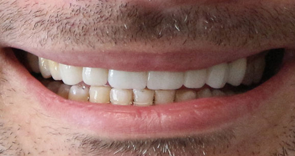 emergency dental implants
