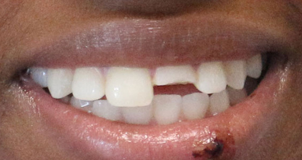 teeth implants