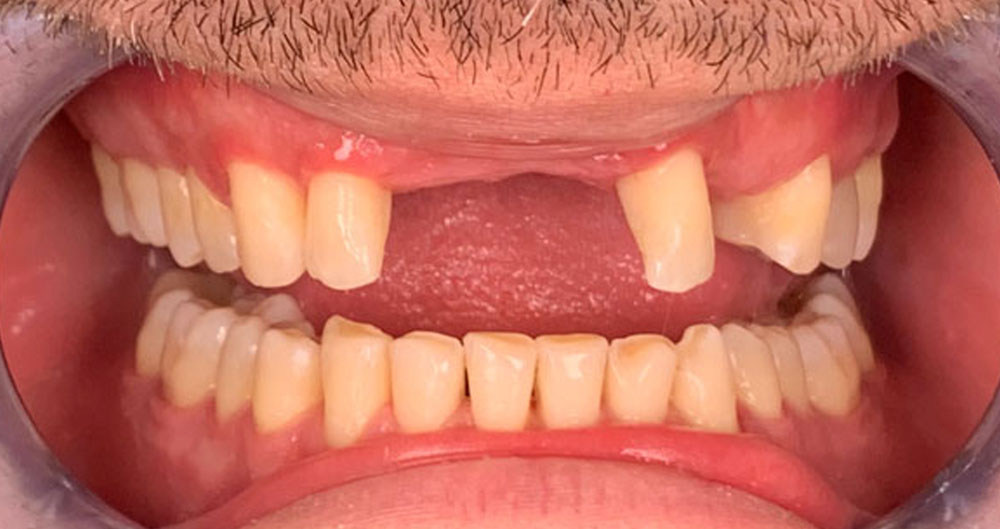 tooth implants
